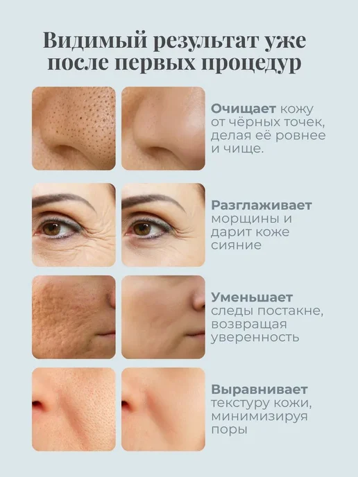 Ультразвуковой скрабер для чистки лица и пилинга кожи, вариант, фото 3