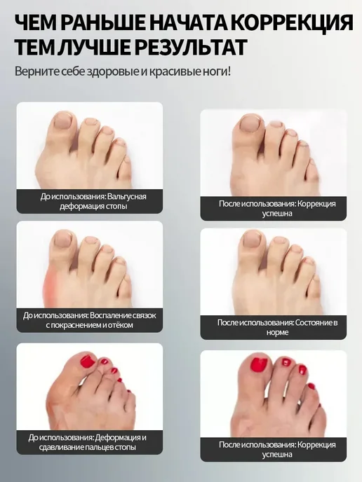 Вальгусный корректор большого пальца ортопедический фиксатор, белый, фото 5